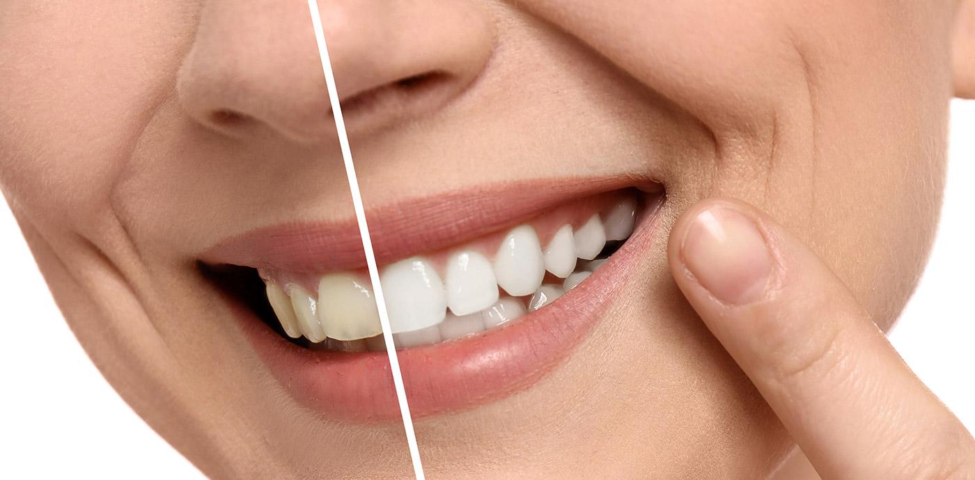 Image of a smile before and after teeth whitening.
