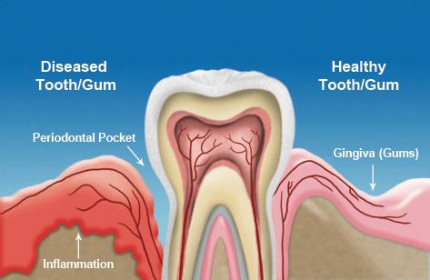 Diagram of Gum Disease in a tooth structure.