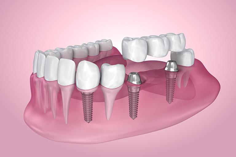 Diagram of a dental implant.
